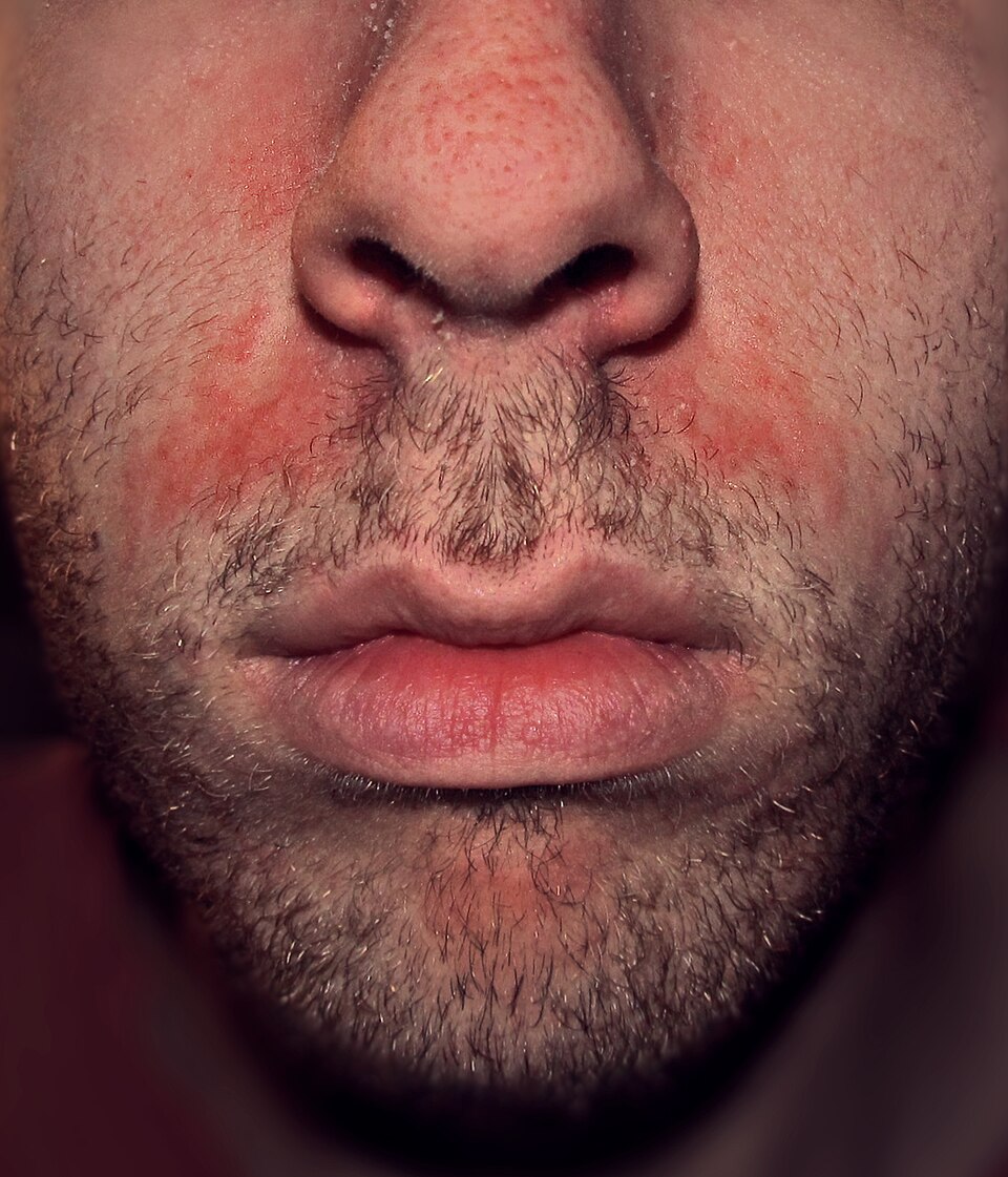 Fayl:Seborrhoeic dermatitis highres.jpg