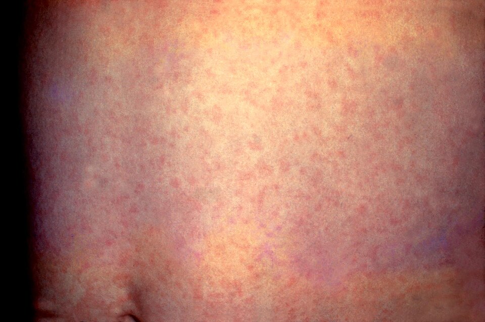 Fayl:Rubella.jpg