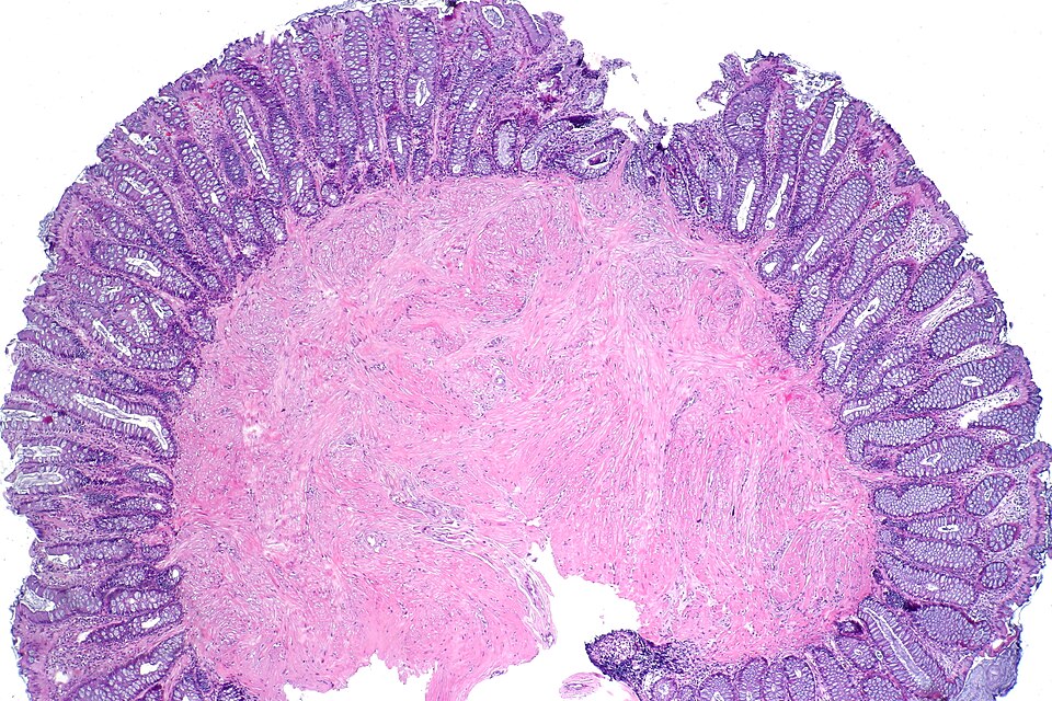 Fayl:Colonic leiomyoma, low mag.jpg