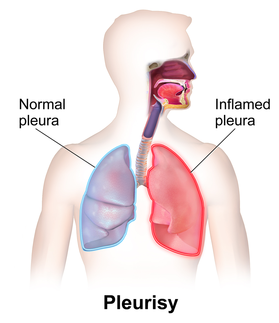 Fayl:Pleurisy.png