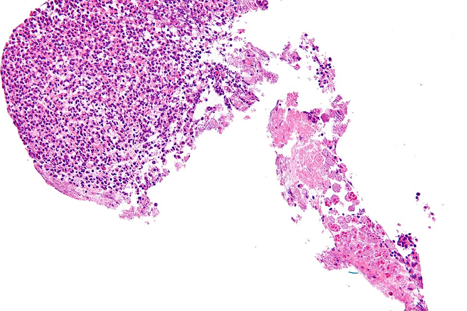 Fayl:Amebiasis - high mag.jpg