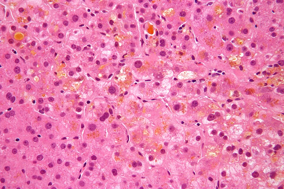 Fayl:Cholestasis high mag.jpg