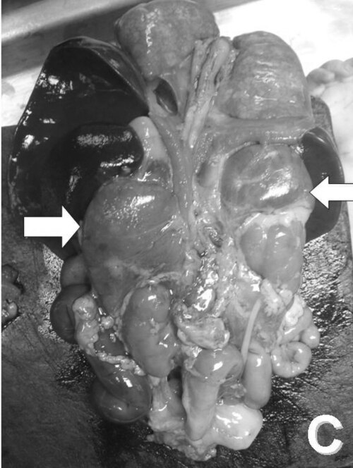Fayl:Congenital adrenal hyperplasia.jpg