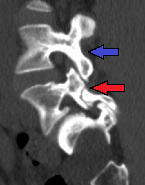 Fayl:SpondyloL5S1CTSagMark.png
