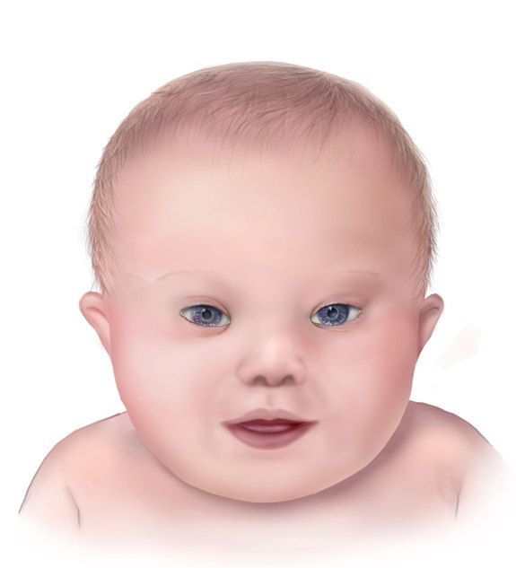 Fayl:Down syndrome lg.jpg