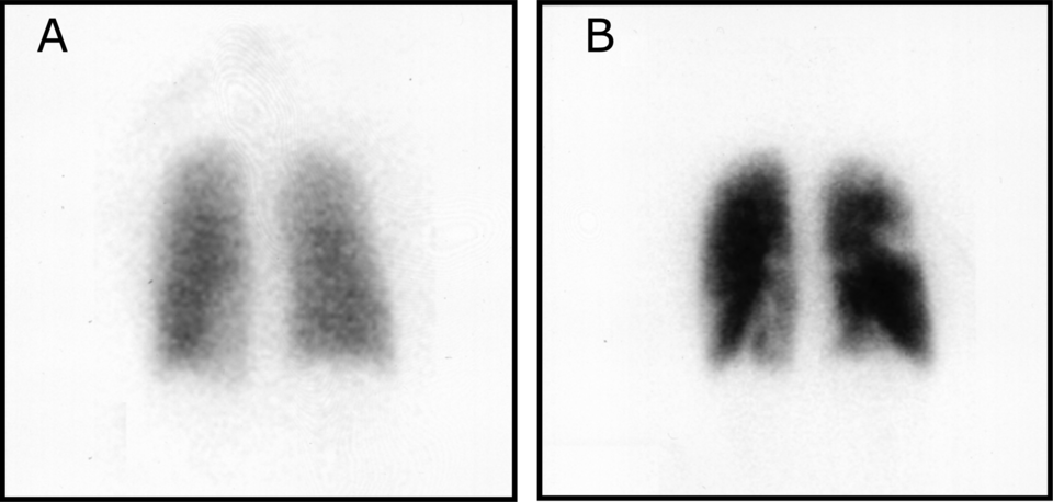 Fayl:Pulmonary embolism scintigraphy PLoS.png