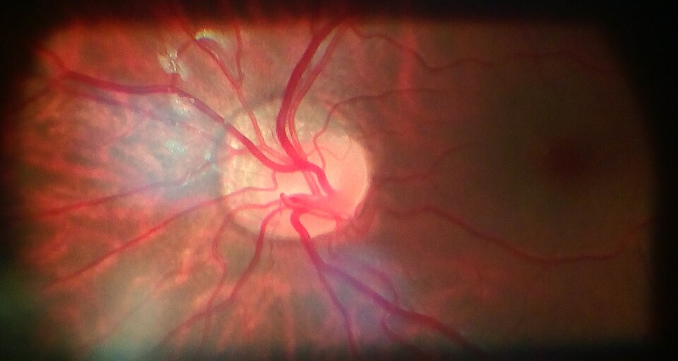 Fayl:Tilted Disc Syndrome.jpg