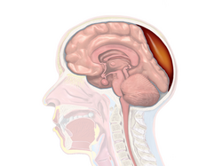 Epidural gematoma tasvirlangan diagramma.