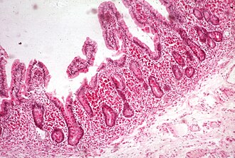 Endoskopik biopsiya