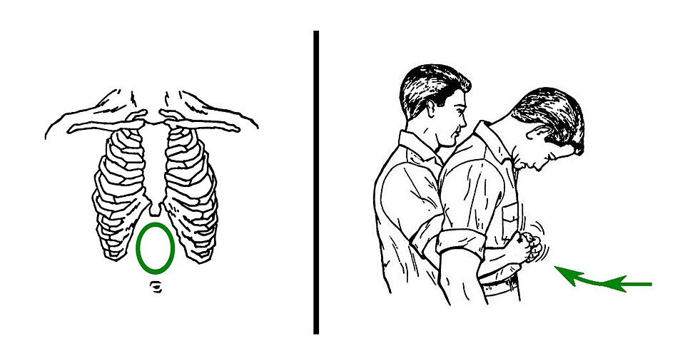 Fayl:Abdominal thrusts against choking.jpg
