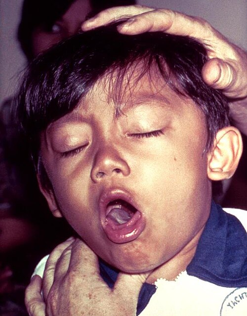 Fayl:Pertussis.jpg