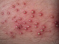 Folliculitis2