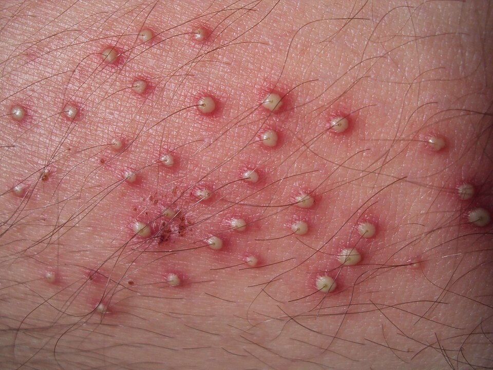 Fayl:Folliculitis2.jpg