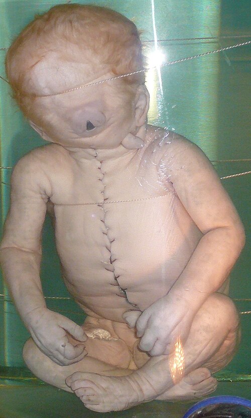 Fayl:Child with Cyclopia.jpg