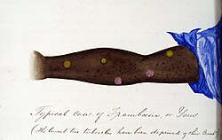 Ichki tomonida koʻplab pushti oʻsimtalar boʻlgan uzatilgan qoʻl