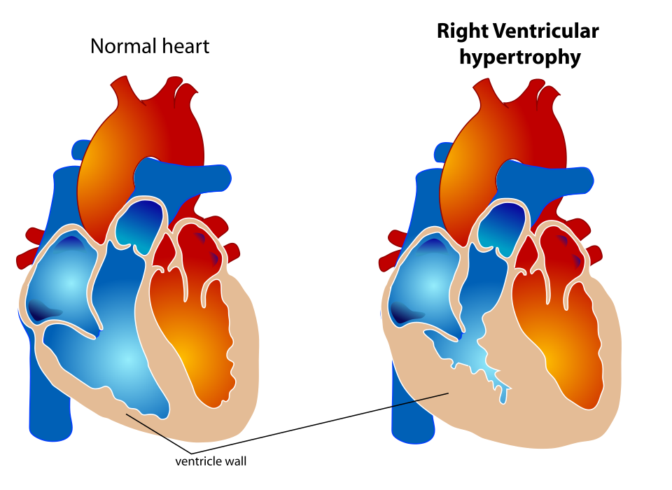 Fayl:Right Ventricular hypertrophy.svg