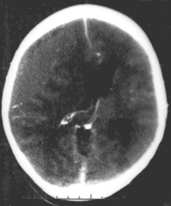 Yosh ayollarda jarohatsiz epidural gematoma. Yuqori oʻng tomondagi kulrang soha gematoma hosil qilib, qorincha oʻrta chizigʻi siljishi va siqilishiga sabab boʻladi.