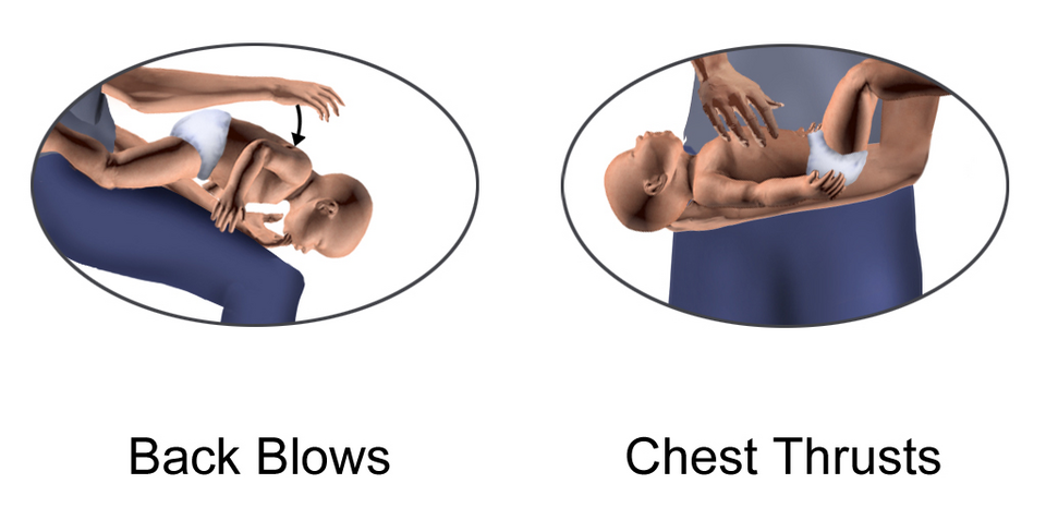 Fayl:Heimlich Infant.png
