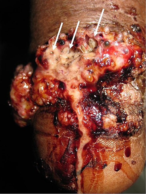 Fayl:Myiasis - heel.jpeg
