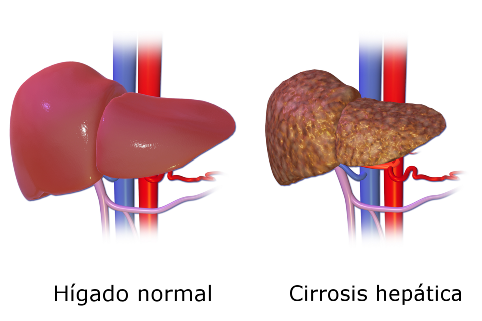 Fayl:Liver Cirrhosis es.png