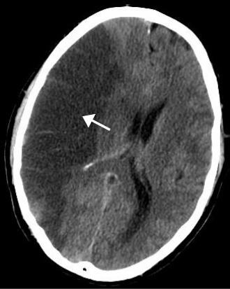 Fayl:MCA Territory Infarct.svg