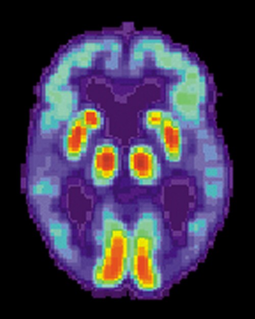 Fayl:PET Alzheimer.jpg