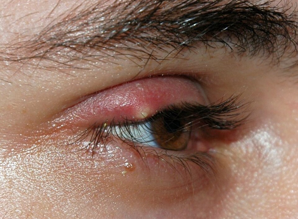 Fayl:Stye02.jpg