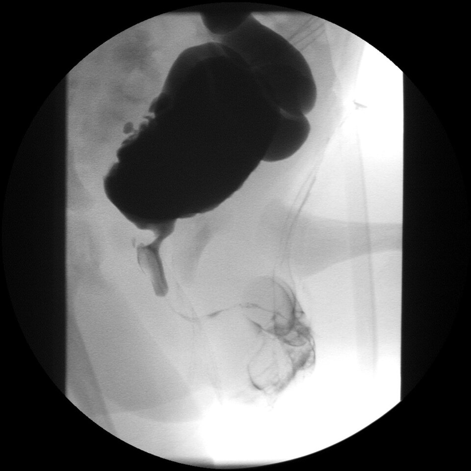 Fayl:Urethralklappe.jpg