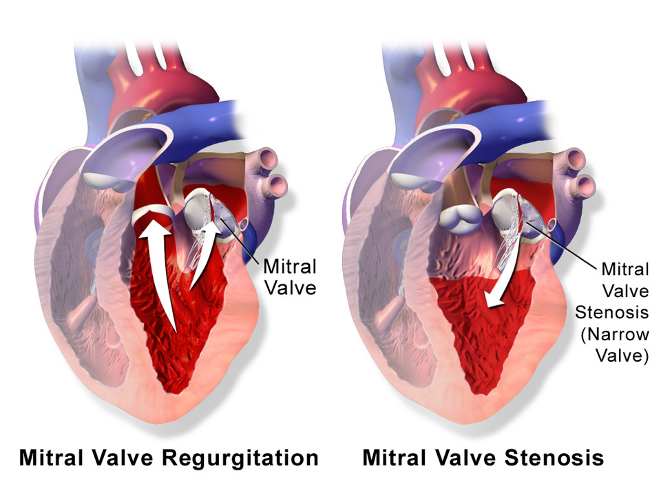 Fayl:Blausen 0645 MitralValve RegurgitationvsStenosis.png