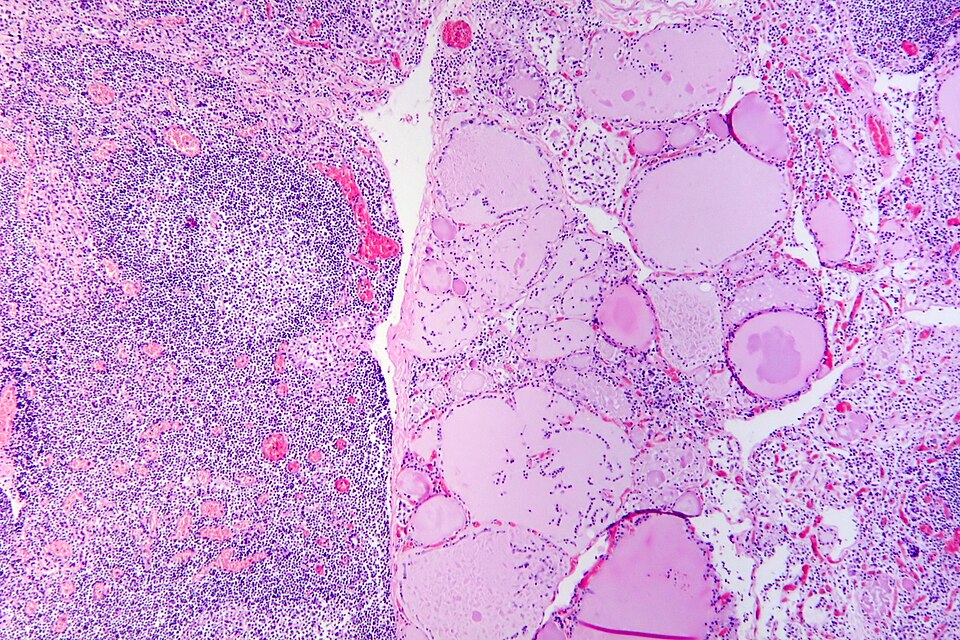 Fayl:Hashimoto's thyroiditis, HE 1.jpg