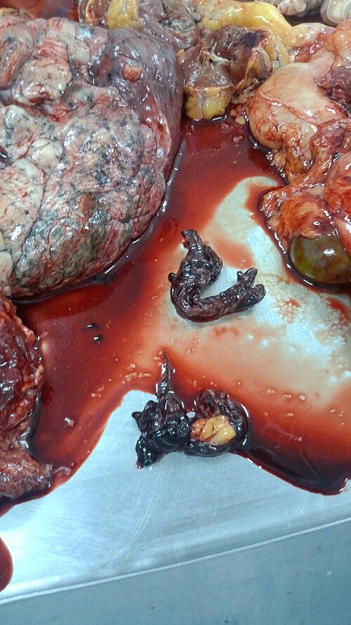 Fayl:Pulmonary embolism 2.jpg