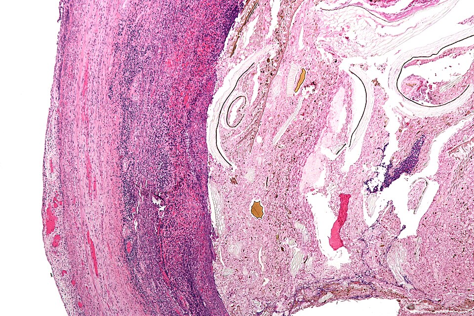 Fayl:Appendicitis - low mag.jpg