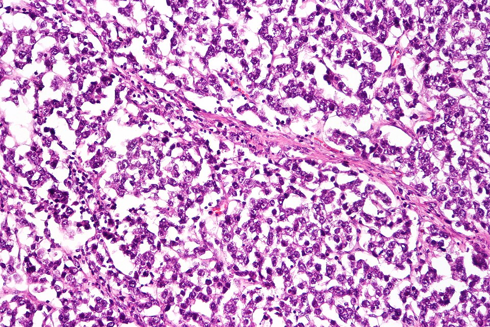 Fayl:Dysgerminoma, high mag.jpg