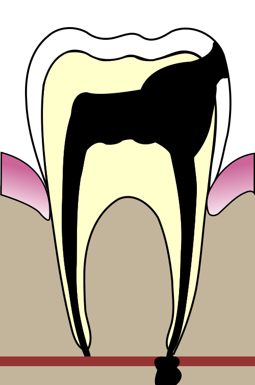 Fayl:Cavities evolution 5.svg