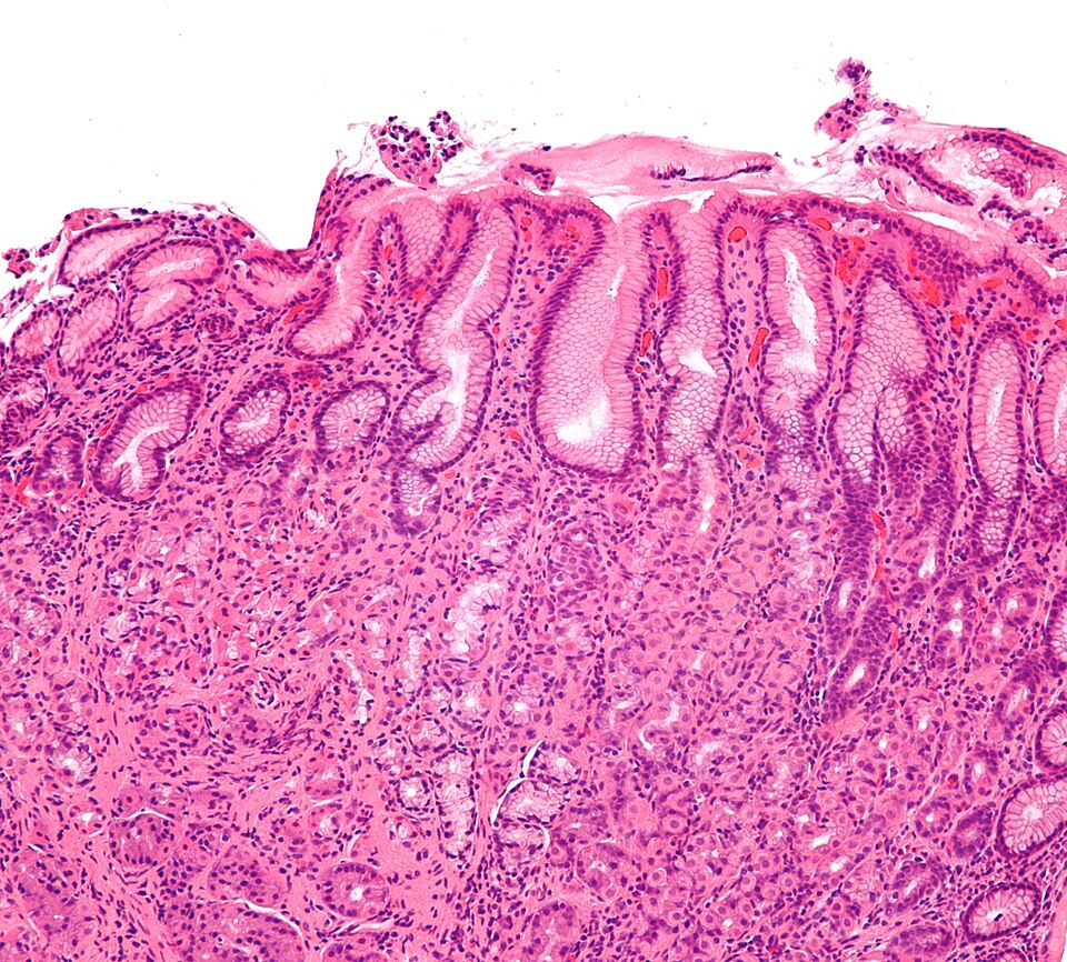 Fayl:Gastritis helicobacter - intermed mag.jpg