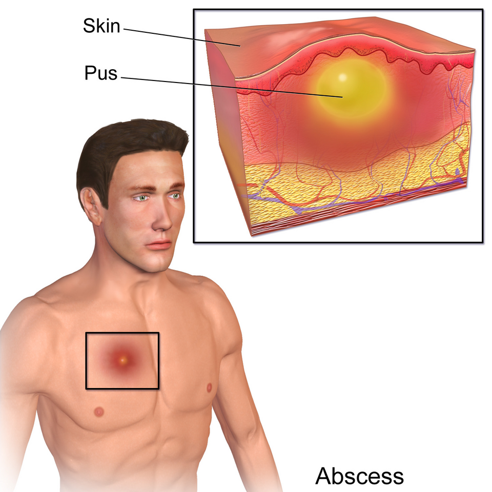 Fayl:Blausen 0007 Abscess.png