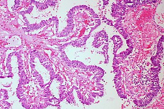Papiller : fibrovaskulyar yadrolar atrofida epiteloid hujayralarining oʻsimtalari.