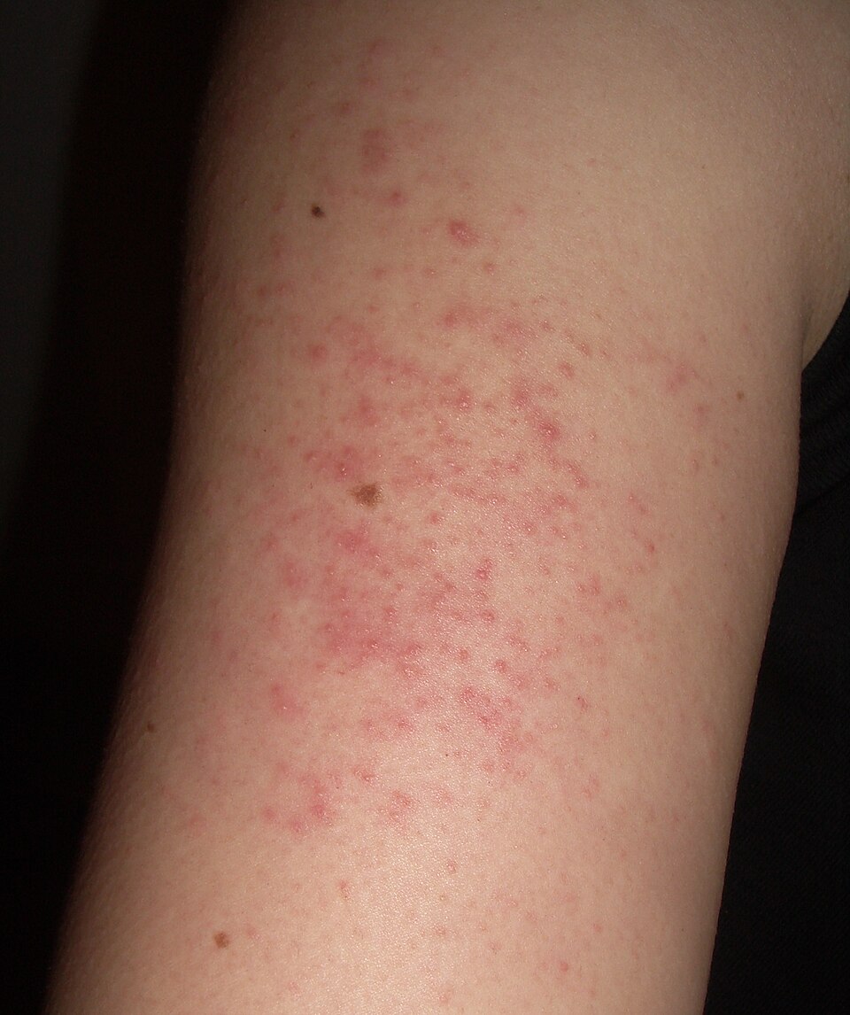 Fayl:Keratosis pilaris arm.jpg