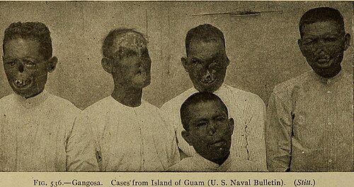 Ogʻir uchlamchi frambeziya; gangoza