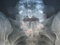 S-1 umurtqa occultaning rentgen tasviri.