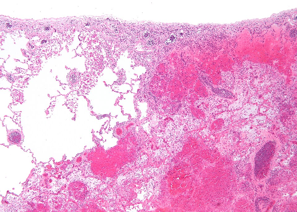 Fayl:Pulmonary infarct intermed mag.jpg