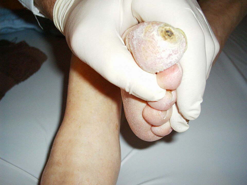Fayl:Diabetisches Fußsyndrom.jpg