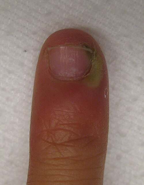 Fayl:Infectionofcutical.JPG