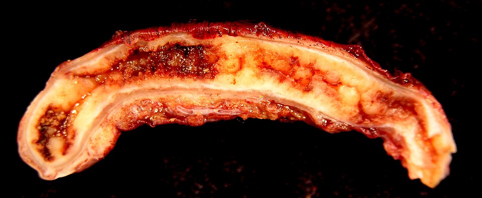 Fayl:Acute Appendicitis.jpg
