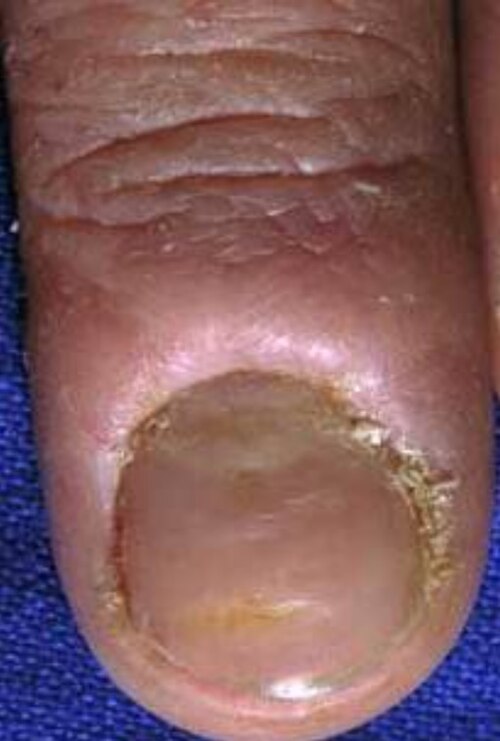 Fayl:ChronicParonychia.jpg