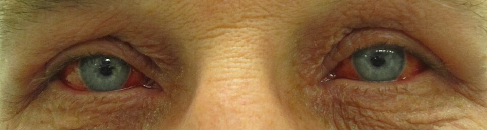 Fayl:Hemorragicconjunctivitis2.jpg