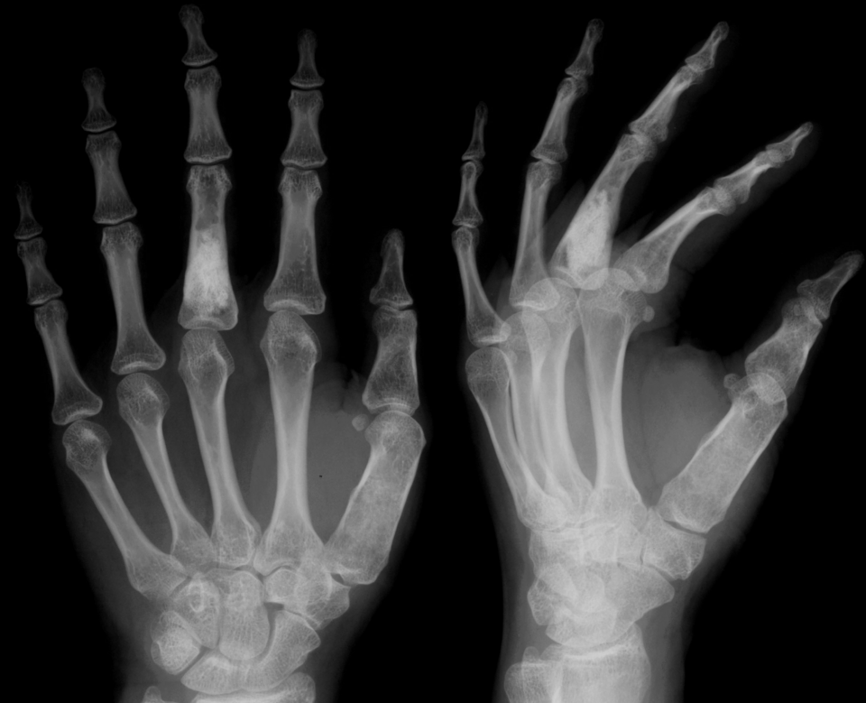 Fayl:Morbus Ollier Finger Roentgen.png