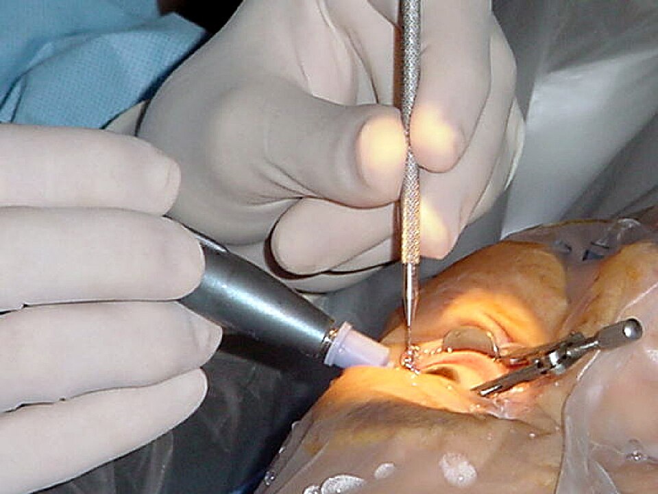 Fayl:Cataract surgery.jpg