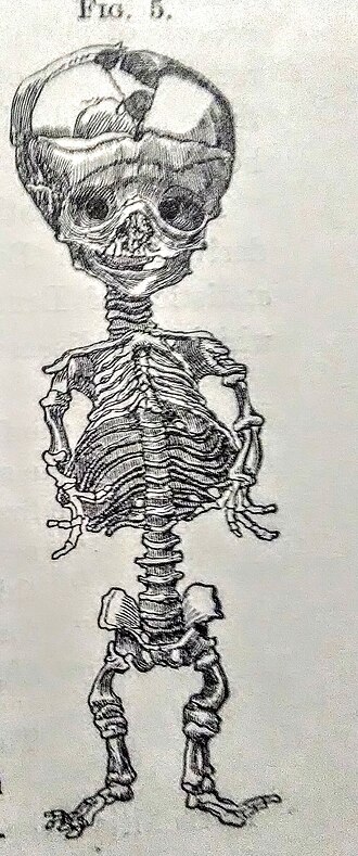 Fayl:Skeleton Infant Rickets.jpeg