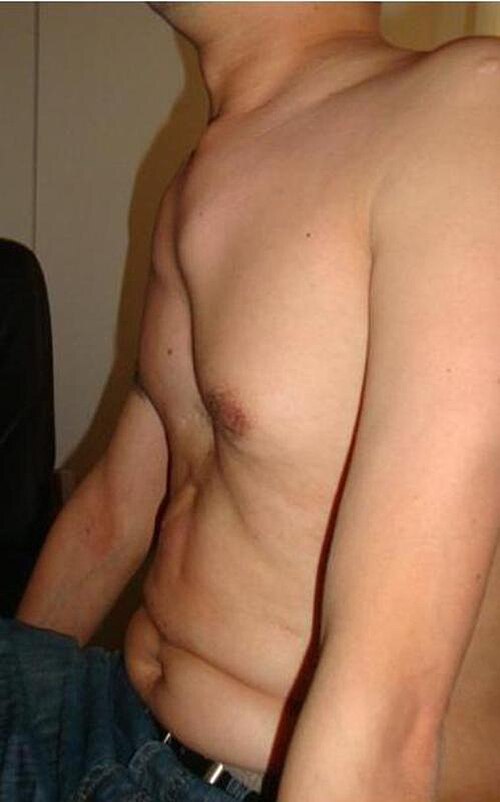Fayl:MarfanChest.jpg